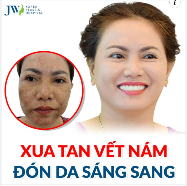 XUA TAN VẾT NÁM, ĐÓN DA SÁNG SANG