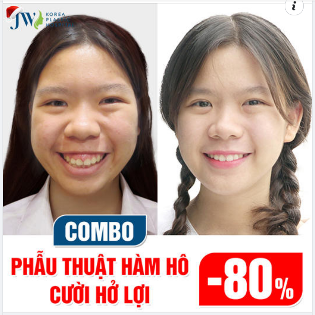 XUẤT SẮC: THĂNG HẠNG NHAN SẮC NHỜ PHẪU THUẬT HÀM HÔ VÀ CHỮA CƯỜI HỞ LỢI