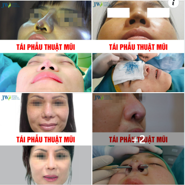 BÁC SĨ TÚ DUNG NHÓI LÒNG TRƯỚC NHỮNG BỆNH NHÂN NHẸ DẠ CẢ TIN NÂNG MŨI Ở CƠ SỞ KÉM UY TÍN