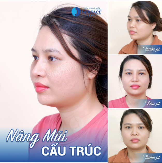 Bạn ấy nâng mũi cấu trúc và gương mặt bây giờ đã xinh xắn hơn xưa rất nhiều rồi phải không nào