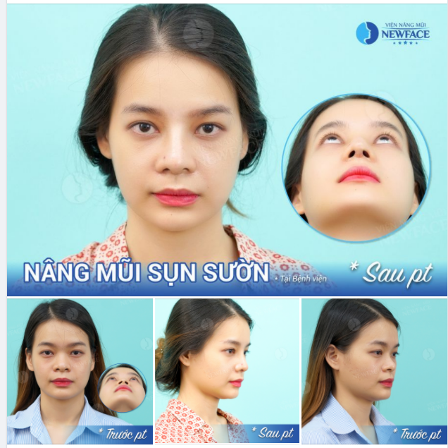 BẠN CHO LỖ MŨI HẠT CHANH NÀY MẤY ĐIỂM