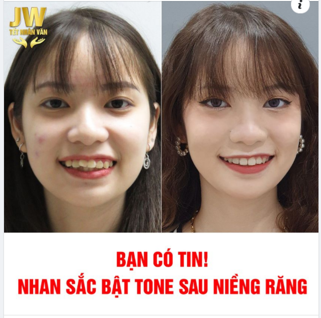 BẠN CÓ TIN! NHAN SẮC BẬT TONE SAU NIỀNG RĂNG
