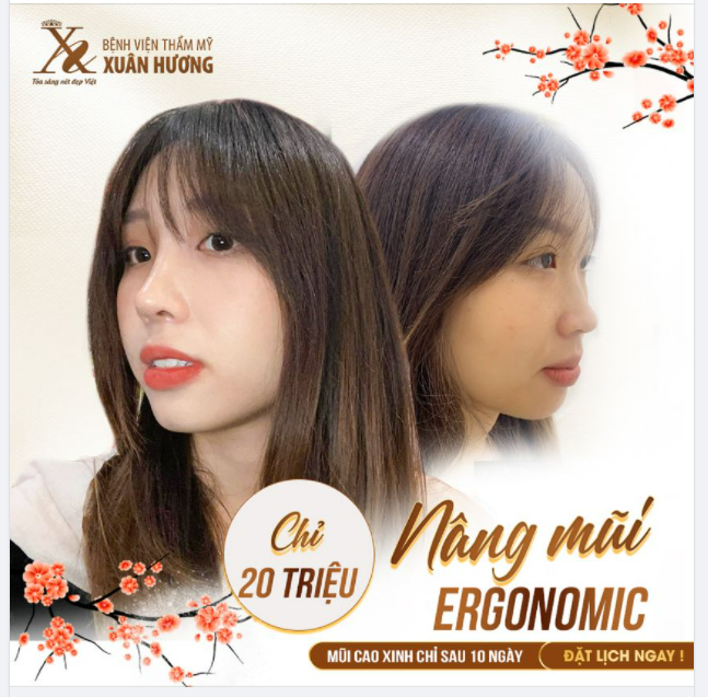 BẬT MÍ BÍ QUYẾT GIÚP NÂNG MŨI ERGONOMIC TẠI BVTM XUÂN HƯƠNG NHANH HỒI PHỤC HƠN KHÁC PHƯƠNG PHÁP KHÁC