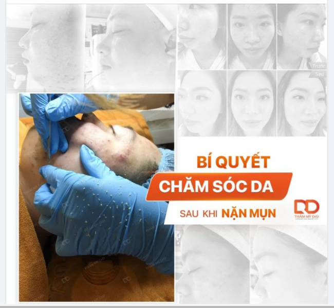 BÍ QUYẾT CHĂM SÓC DA SÁNG MỊN SAU KHI NẶN MỤN DÙ ĐÃ CẬN TẾT.