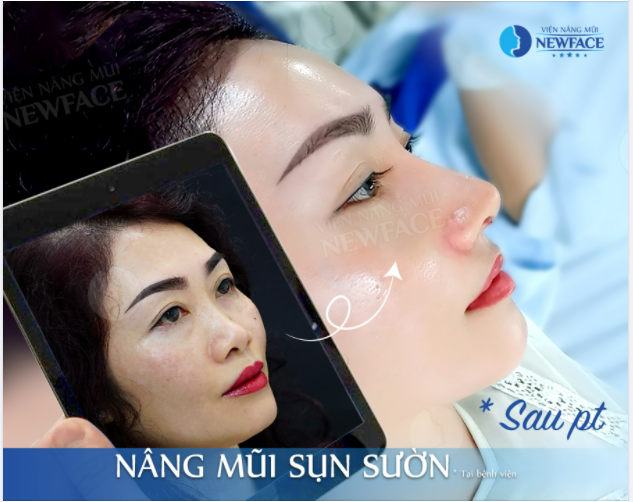 BIẾN HÓA HOÀN HẢO NHỜ NÂNG MŨI SỤN SƯỜN