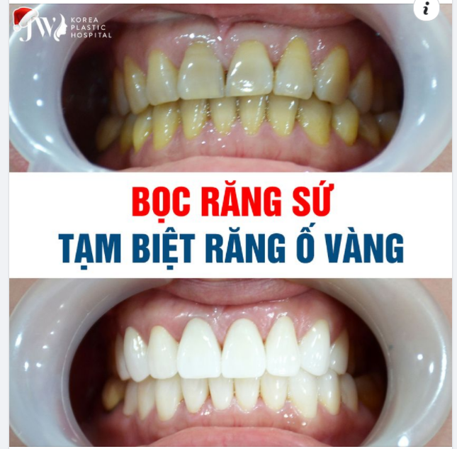 BỌC RĂNG SỨ TRẮNG SÁNG NỞ NỤ CƯỜI ĐÓN XUÂN VUI
