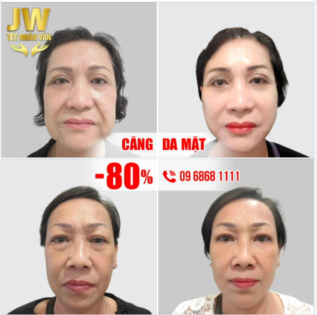 CĂNG DA MẶT MESH LIFT XOÁ SẠCH NẾP NHĂN CHỈ TRONG 45 PHÚT