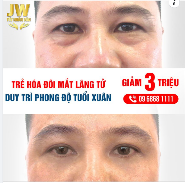 CẮT MẮT TUỔI TRUNG NIÊN- THÊM PHONG ĐỘ VỮNG THÀNH CÔNG