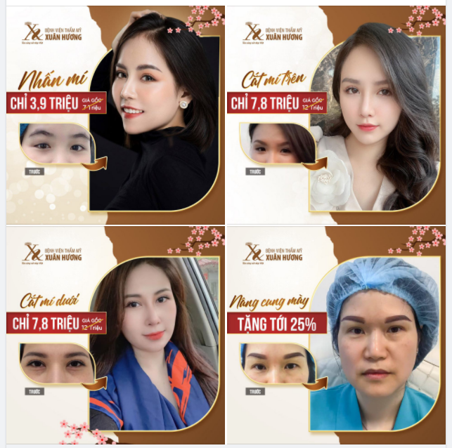 Cắt mí - Đến Xuân Hương; Nhấn mí - Đến Xuân Hương Làm Thẩm mỹ mắt - Nhất định phải đến Xuân Hương!