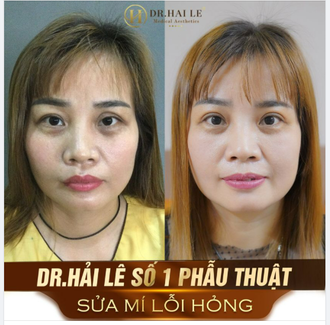 CẮT MÍ ĐẸP ĐÃ KHÓ, SỬA LẠI MÍ ĐÃ BỊ CẮT HỎNG CÒN KHÓ HƠN GẤP BỘI.!