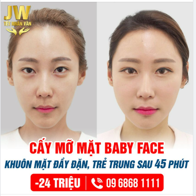 CẤY MỠ MẶT BABY FACE SỞ HỮU KHUÔN MẶT ĐẦY ĐẶN, TRẺ TRUNG CHỈ SAU 45 PHÚT.