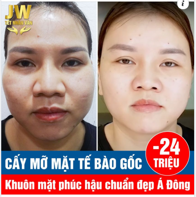 CẤY MỠ MẶT TẾ BÀO GỐC HỒI XUÂN GƯƠNG MẶT ĐẦY ĐẶN PHÚC HẬU