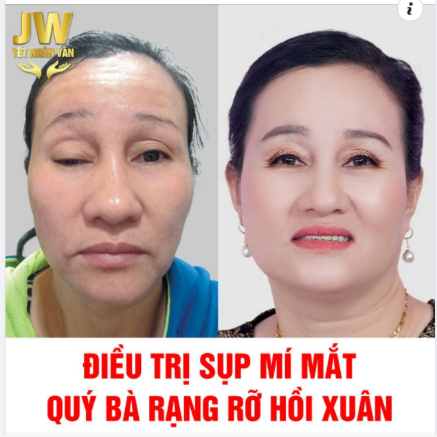 CHIA TAY ĐÔI MẮT LỜ ĐỜ SAU MỘT LẦN ĐIỀU TRỊ SỤP MÍ