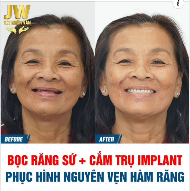 COMBO BỌC RĂNG SỨ+ CẮM TRỤ IMPLANT PHỤC HÌNH RĂNG ĂN TẾT