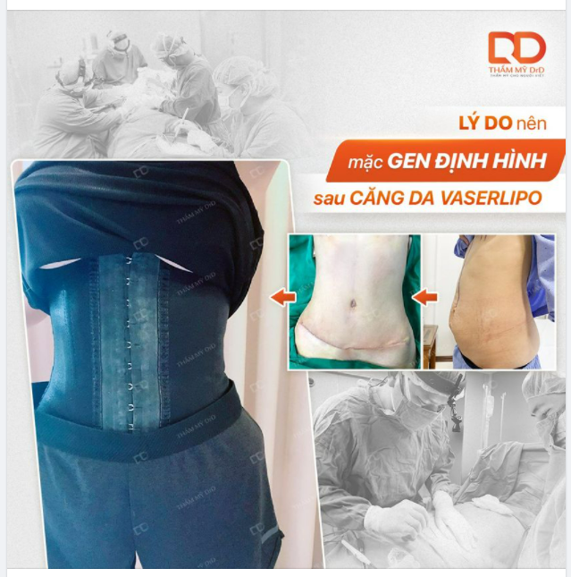 Cũng giống như việc mặc áo định hình sau khi Nâng V1 thì việc đeo gen bụng sau phẫu thuật Hút mỡ hay Căng da bụng cũng rất quan trọng.