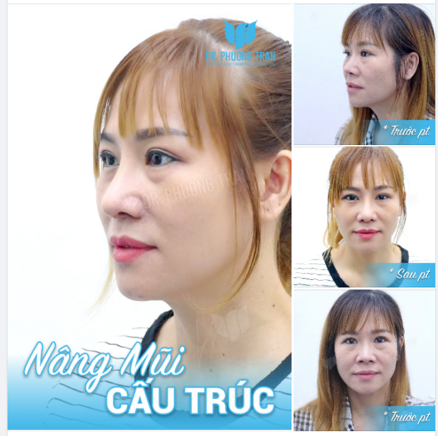 CÙNG LÀ NÂNG MŨI CẤU TRÚC NHƯNG SAO KHÁC NHAU ĐẾN LẠ