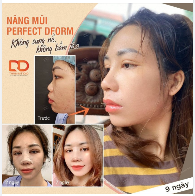 Đây chính là minh chứng cho việc Nâng mũi Perfect Dform không bị sưng nề, bầm tím.