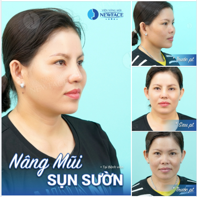 ĐÂY LÀ CHIẾC MŨI BỊ BIẾN CHỨNG CO RÚT