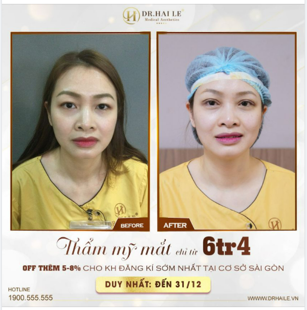ĐIỂM DANH 3 LÝ DO NÊN CHỌN CẮT MÍ TẠI DR.HẢI LÊ
