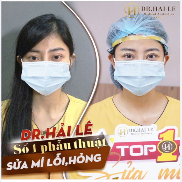 ĐIỀU GÌ THUYẾT PHỤC KHÁCH HÀNG ĐẾN DR.HẢI LÊ ĐỂ “SỬA MÍ” SAU KHI CẮT TẠI CƠ SỞ THIẾU UY TÍN ?