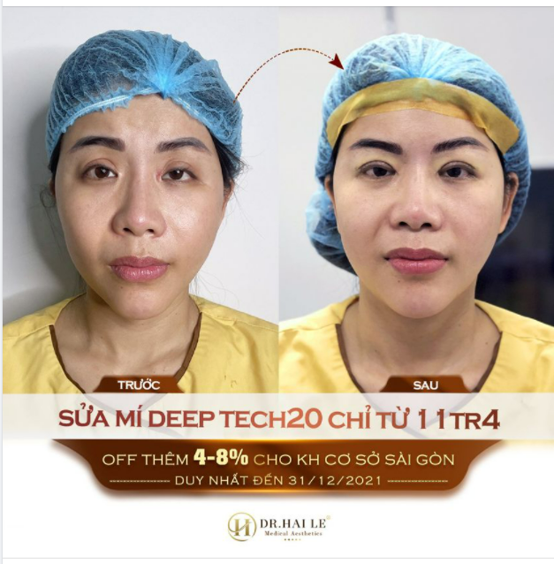 DR.HẢI LÊ - SỐ 1 PHẪU THUẬT SỬA MÍ LỖI, HỎNG!