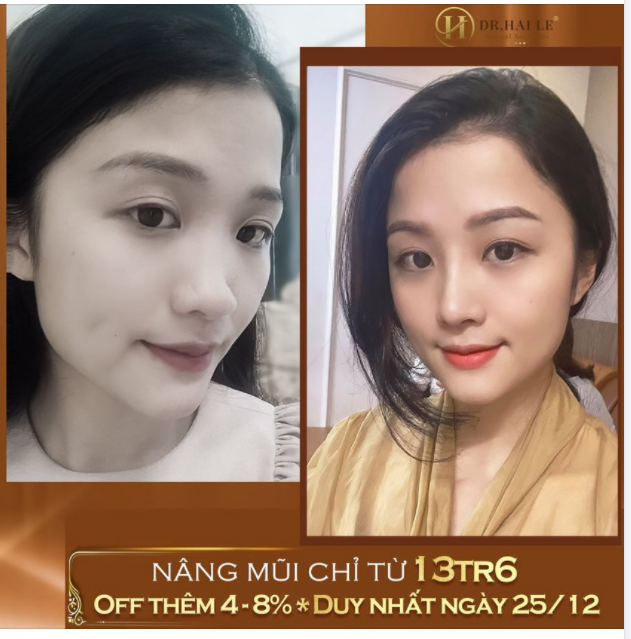 DR.HẢI LÊ TRI ÂN CUỐI NĂM - MŨI ĐẸP GIÁ “SIÊU YÊU”!