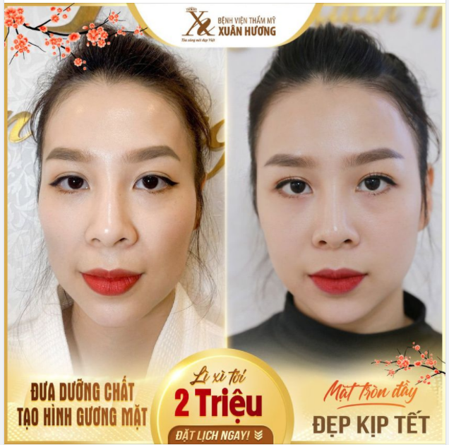 ĐƯA DƯỠNG CHẤT TẠO HÌNH GƯƠNG MẶT - TOP 1 DỊCH VỤ ĐƯỢC YÊU THÍCH NHẤT DỊP CẬN TẾT TẠI BVTM XUÂN HƯƠNG