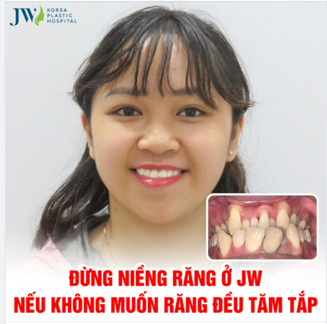 ĐỪNG NIỀNG RĂNG Ở JW (Nếu bạn không muốn răng đẹp xuất sắc)