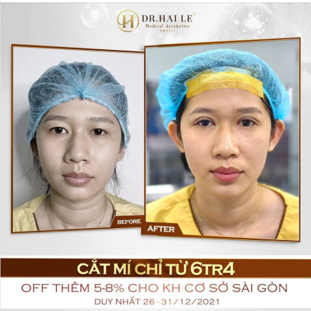 ĐỪNG TỪ CHỐI CƠ HỘI ĐỂ MÌNH XINH ĐẸP HƠN MỖI NGÀY DR.HẢI LÊ - SỐ 1 CẮT MÍ MẮT.!!