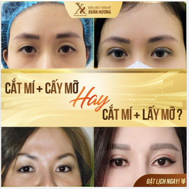 GIẢI PHÁP NÀO CHO TÌNH TRẠNG THỪA HAY THIẾU HỤT MỠ MẮT
