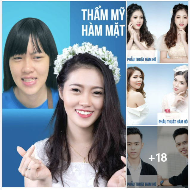 Hàm hô, hàm móm luôn là nỗi ám ảnh của nhiều người, khiến họ tự ti, gặp nhiều bất cập trong giao tiếp và sinh hoạt.