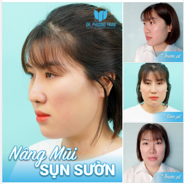 Hãy chú ý vào CHIẾC MŨI LỆCH PHẢI của bạn ấy!