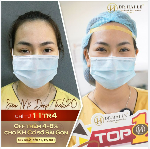 HỐI HẬN VÌ ĐÃ SỐNG TRONG MẶC CẢM QUÁ LÂU MÀ KHÔNG ĐẾN DR.HẢI LÊ SỬA MÍ SỚM HƠN.!!!
