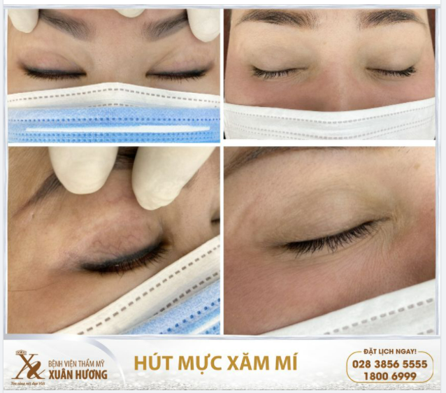 "HÚT 1 LẦN MÀ HẾT SẠCH MỰC XĂM MÍ, NHÌN KẾT QUẢ MÌNH VẪN CHƯA TIN NÓ NHANH THẾ"