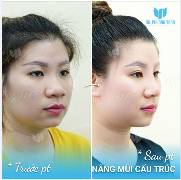 KHI MŨI RẤT TO BÈ MÀ KHÔNG MUỐN CẮT CÁNH
