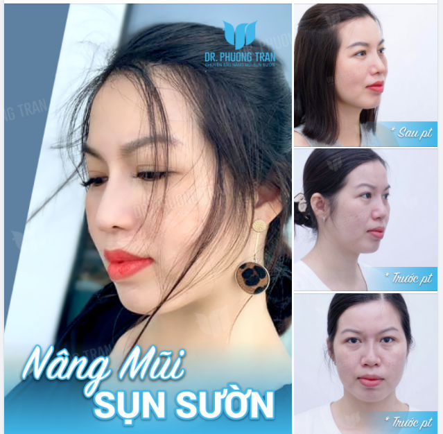 KHI NÂNG MŨI ĐỦ CAO, SẼ BỚT HÔ HÀM