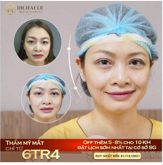 Không ít KH nhắn tin cho Dr.Hải Lê: - Cắt mí bao lâu thì mí đẹp tự nhiên - Cắt mí thời điểm nào để có mí đẹp đón tết