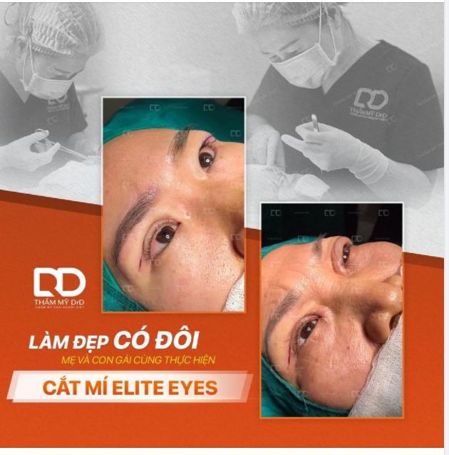 LÀM ĐẸP CÓ ĐÔI - ƯU ĐÃI GẤP BỘI MẸ VÀ CON GÁI CÙNG NHAU THỰC HIỆN CẮT MÍ ELITE EYES