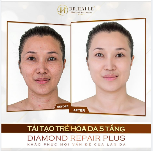 Làn da căng mịn sáng hồng sau 1 liệu trình tái tạo trẻ hóa da DIAMOND REPAIR PLUS , TỰ TIN KHẲNG ĐỊNH "EM CHƯA 28"
