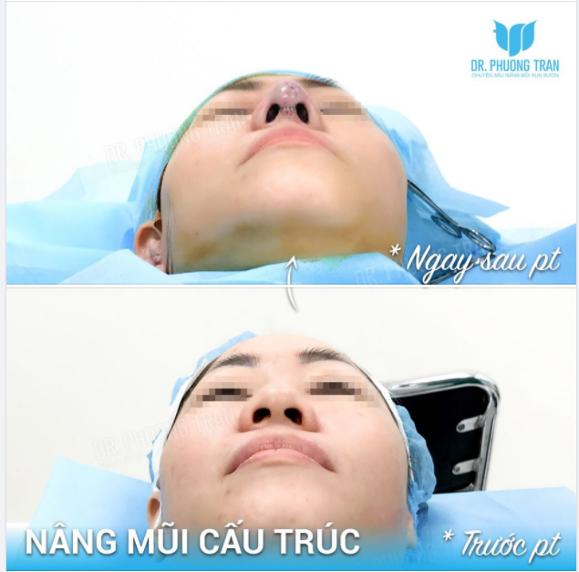 LỖ MŨI HẠT CHANH TRONG “TRUYỀN THUYẾT” LÀ ĐÂY