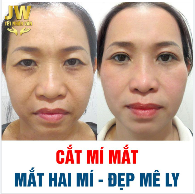 MẮT 2 MÍ - ĐẸP MÊ LY
