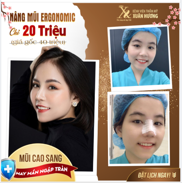 MŨI CAO SANG - ĐÓN NĂM MỚI NGẬP TRÀN MAY MẮN CÙNG NÂNG MŨI ERGONOMIC TẠI BVTM XUÂN HƯƠNG