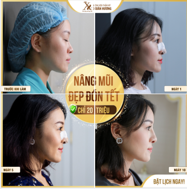 MŨI ĐẸP KỊP TẾT - CHỈ 10 NGÀY ÔM FORM TỰ NHIÊN