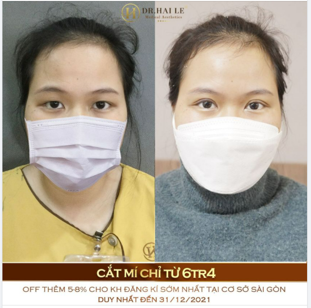 MUỐN CÓ MÍ ĐẸP CHUẨN XINH - LỰA CHỌN ĐÚNG ĐẮN NHẤT LÀ DR.HẢI LÊ.!
