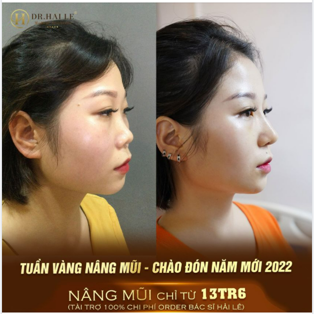 "Muốn có mũi đẹp để Tết đi chơi thì tầm này nâng là chuẩn xinh rồi"
