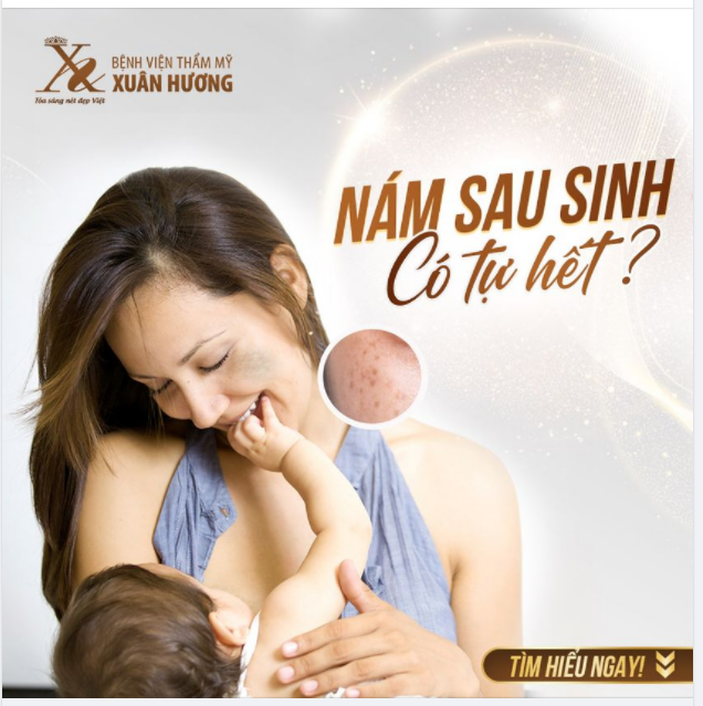 NÁM DA SAU SINH CÓ THỂ TỰ HẾT ĐƯỢC KHÔNG?
