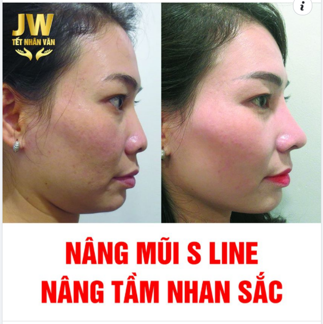 NÂNG MŨI S LINE - NÂNG TẦM NHAN SẮC, KHAI THÔNG ĐỔI VẬN