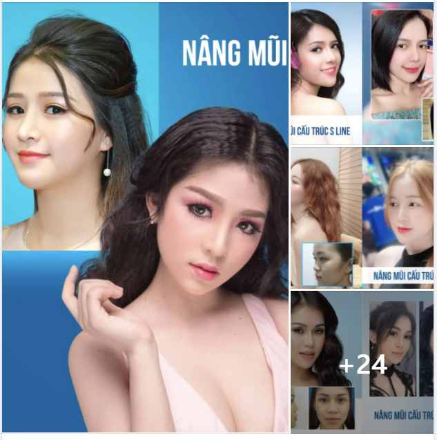 Nâng Mũi S Line – Sở Hữu Mũi Đẹp Thách Thức Mọi Góc Nhìn