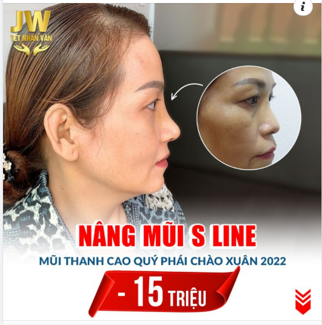 NÂNG MŨI S LINE THUẬN PHONG THỦY THÊM PHÁT TÀI ĐẸP LÂU DÀI