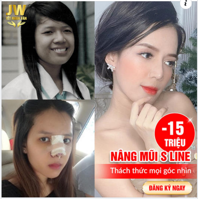 NÂNG MŨI S LINE- ĐẸP MÃI KHÔNG PHAI